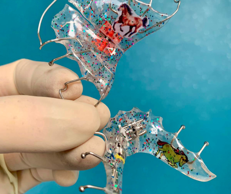 Customisation d'appareils dentaires pour les traitements d'orthodontie à Marseille