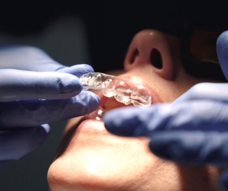 Traitement d'orthodontie par aligneurs invisibles