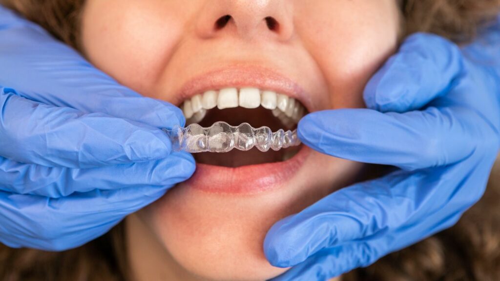 Les avantages de l'orthodontie invisible