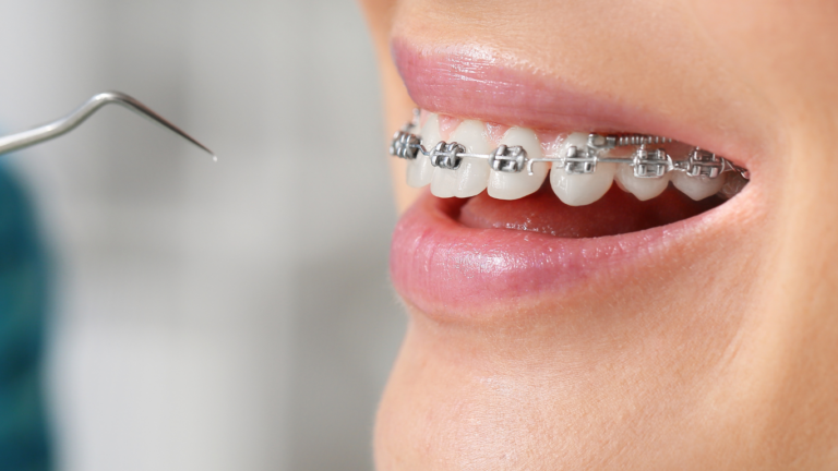 Comment l’orthodontie peut améliorer votre digestion et santé générale ?